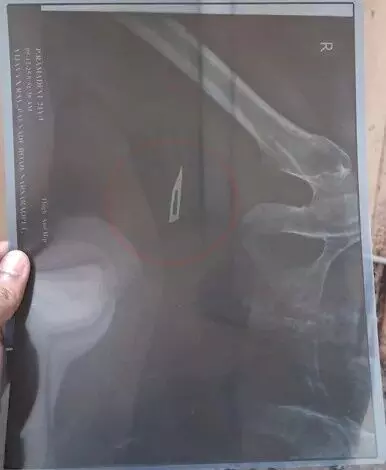 రమాదేవి తొడలో సర్జికల్ బ్లేడు