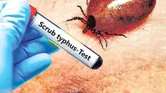 ఆంధ్రప్రదేశ్‌లో స్క్రబ్‌ టైఫస్‌ భయాందోళనలు